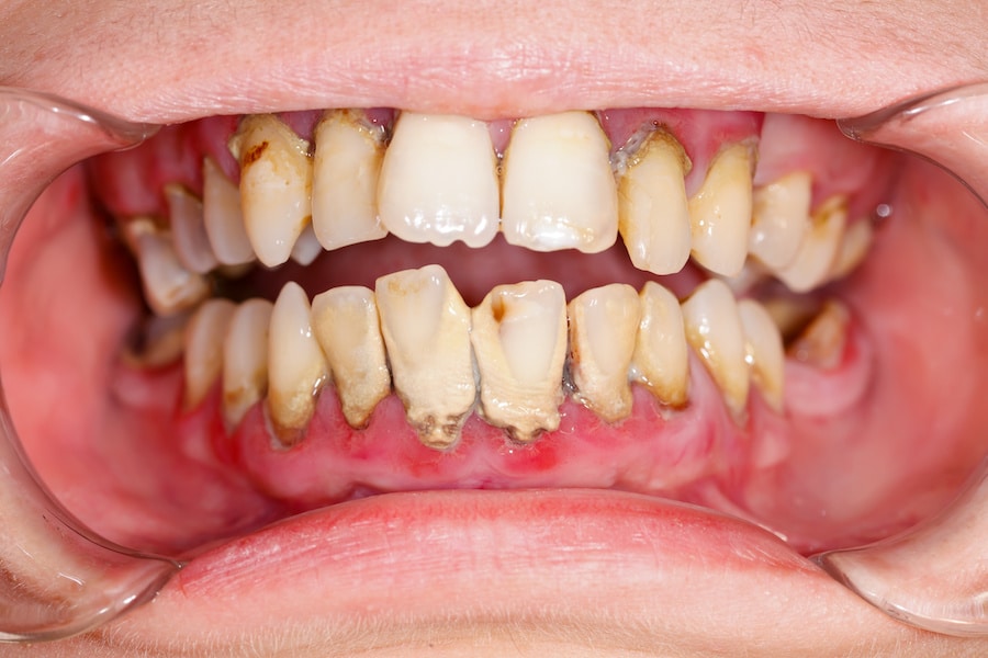 Plaque build up on teeth